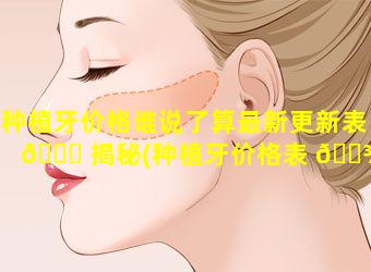 种植牙价格谁说了算最新更新表 🐟 揭秘(种植牙价格表 🌾 是多少钱一个)